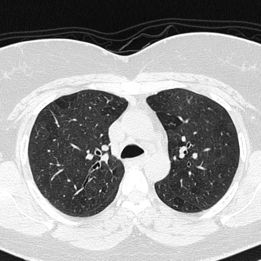 Air trapping in small airway disease (Radiopaedia 61685-69694 Axial lung window 54).jpg