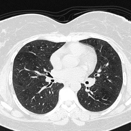 Air trapping in small airway disease (Radiopaedia 61685-69694 Axial lung window 83).jpg