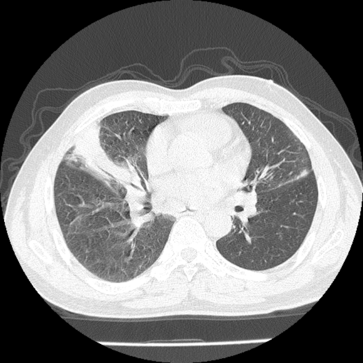 Airway foreign body in adult (Radiopaedia 85907-101779 Axial lung window 97).jpg