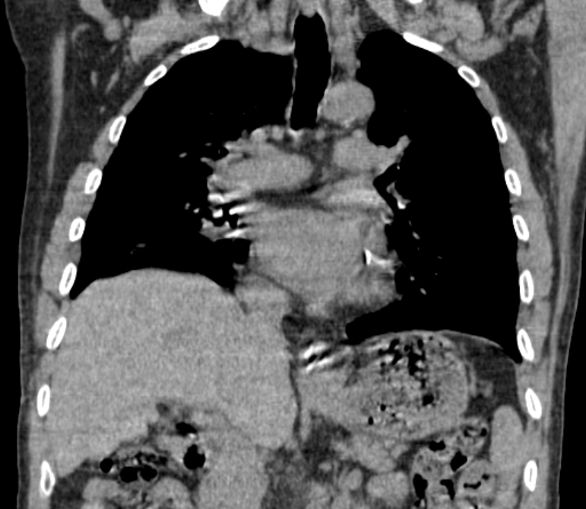 Airway foreign body in adult (Radiopaedia 85907-101779 Coronal liver window 132).jpg