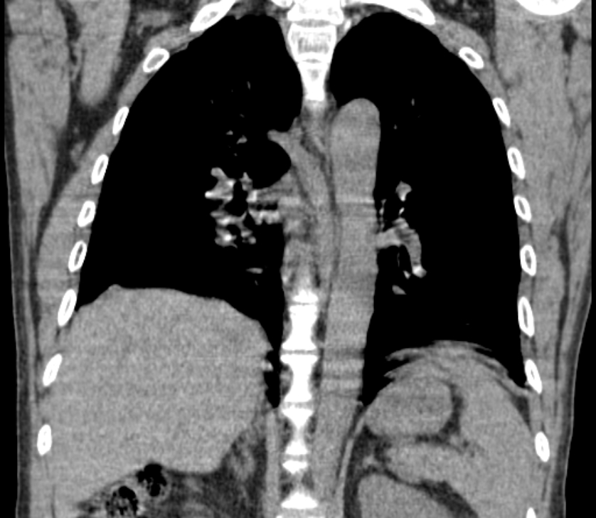 Airway foreign body in adult (Radiopaedia 85907-101779 Coronal liver window 172).jpg
