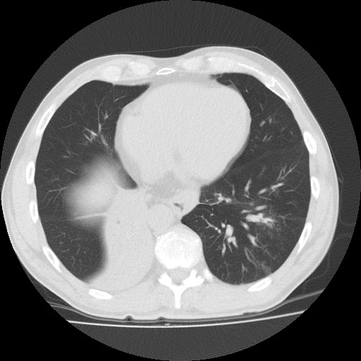 Allergic bronchopulmonary aspergillosis (ABPA) (Radiopaedia 60594-68313 Axial lung window 43).jpg