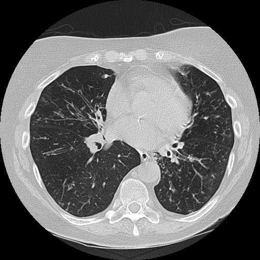 Alpha-1-antitrypsin deficiency (Radiopaedia 72058-82557 Axial lung window 44).jpg