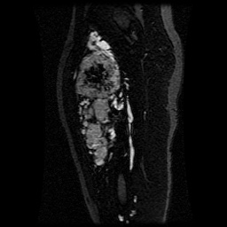 Alveolar soft part sarcoma (Radiopaedia 64501-73678 D 74).jpg