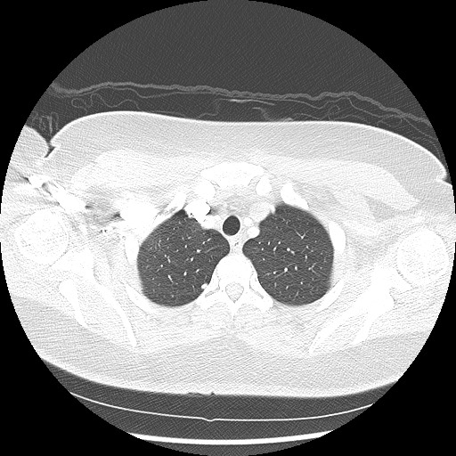 Alveolar soft part sarcoma - right leg (Radiopaedia 59432-67091 Axial lung window 19).jpg