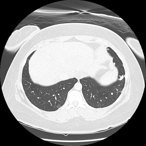 Alveolar soft part sarcoma - right leg (Radiopaedia 59432-67091 Axial lung window 93).jpg