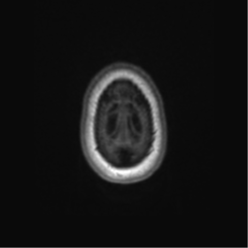 File:Alzheimer's disease (Radiopaedia 42658-45802 Axial T1 14).png