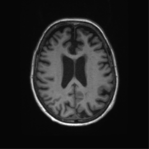 File:Alzheimer's disease (Radiopaedia 42658-45802 Axial T1 60).png
