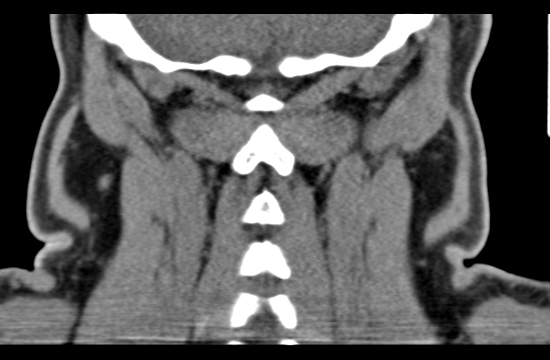 Ameloblastoma (Radiopaedia 33677-34806 Coronal non-contrast 57).png