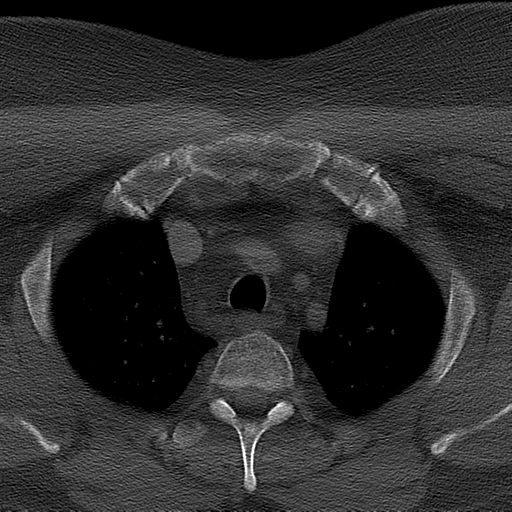Ameloblastoma (Radiopaedia 38520-40623 Axial bone window 81).png
