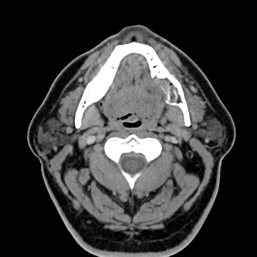 File:Ameloblastoma (Radiopaedia 38520-40623 Axial non-contrast 30).png