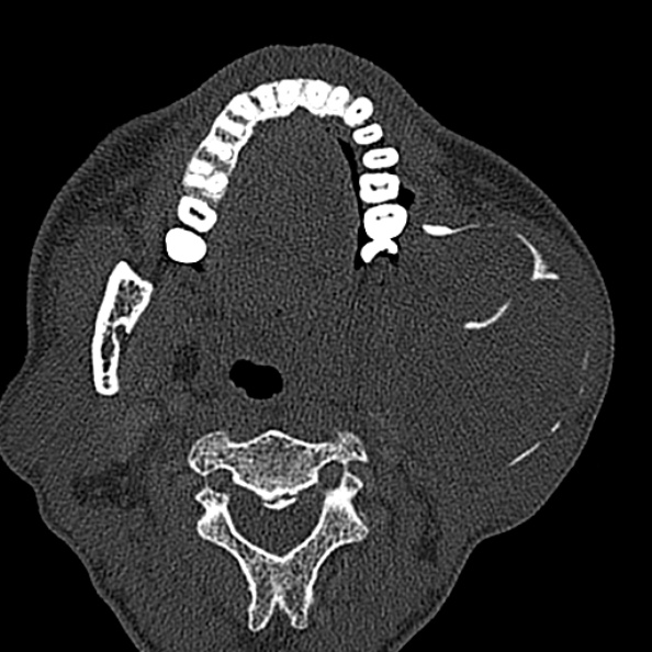 Ameloblastoma (Radiopaedia 51921-57766 Axial bone window 88).jpg