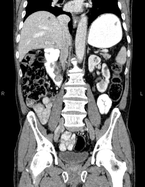Ampullary adenocarcinoma (Radiopaedia 86093-102032 C 39).jpg