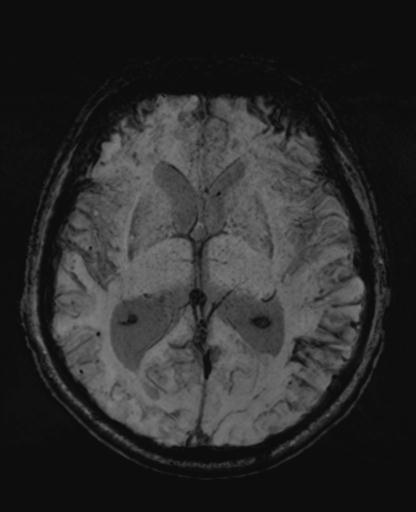 File:Amyloid angiopathy with inflammation (Radiopaedia 30360-31002 Axial SWI MIP 27).jpg