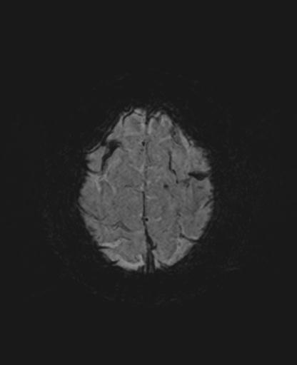 File:Amyloid angiopathy with inflammation (Radiopaedia 30360-31002 Axial SWI MIP 57).jpg