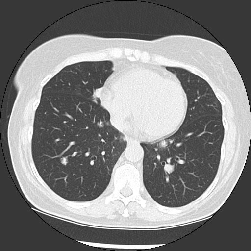 File:Amyloidosis - bronchial and diffuse nodular pulmonary involvement (Radiopaedia 60156-67744 B 39).jpg