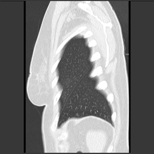 File:Amyloidosis - bronchial and diffuse nodular pulmonary involvement (Radiopaedia 60156-67744 F 51).jpg