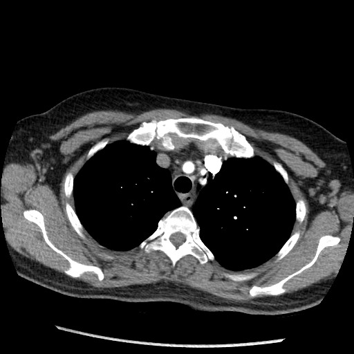 Amyloidosis - bronchial and diffuse nodular pulmonary involvement (Radiopaedia 60156-67745 A 11).jpg