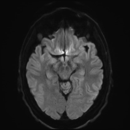 File:Amyotrophic lateral sclerosis (Radiopaedia 87352-103658 Axial DWI 39).jpg
