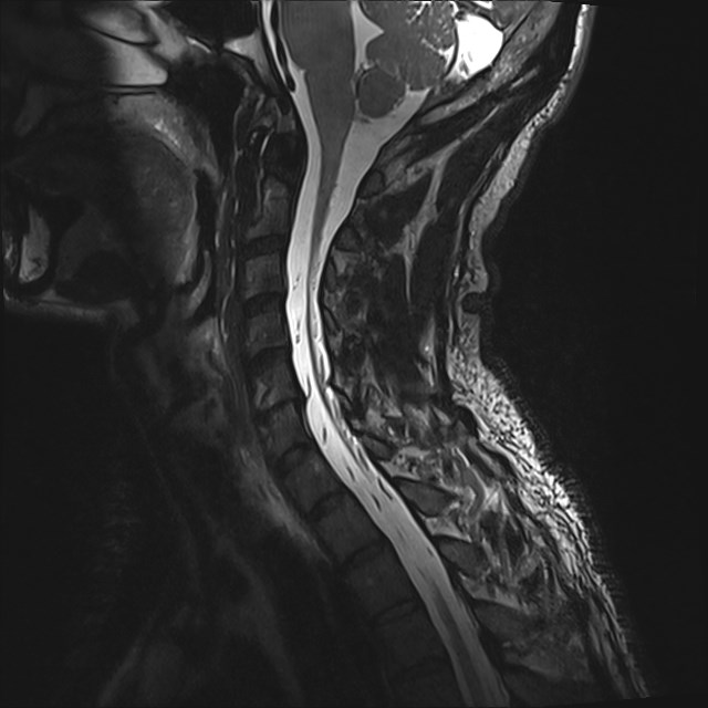 Amyotrophic lateral sclerosis (Radiopaedia 87352-103658 I 23).jpg