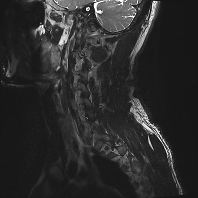Amyotrophic lateral sclerosis (Radiopaedia 87352-103658 I 60).jpg