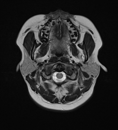 File:Anaplastic astroblastoma (Radiopaedia 55666-62194 Axial T2 1).png