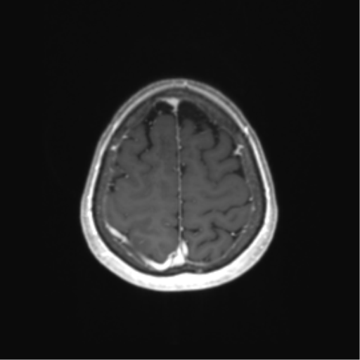 File:Anaplastic astrocytoma (Radiopaedia 86943-103160 Axial T1 C+ 74).png