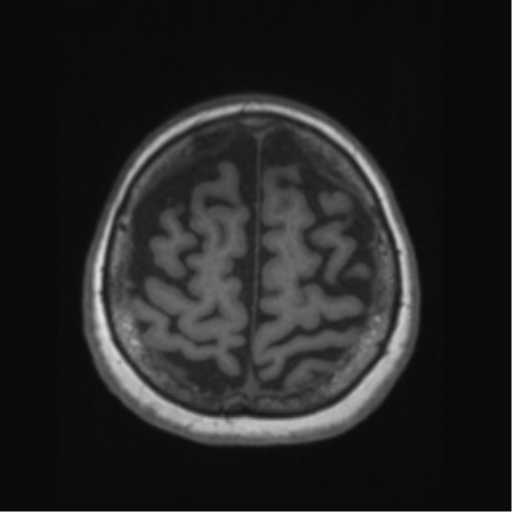 Anaplastic astrocytoma IDH wild-type (pseudoprogression) (Radiopaedia 42209-45276 Axial T1 124).png