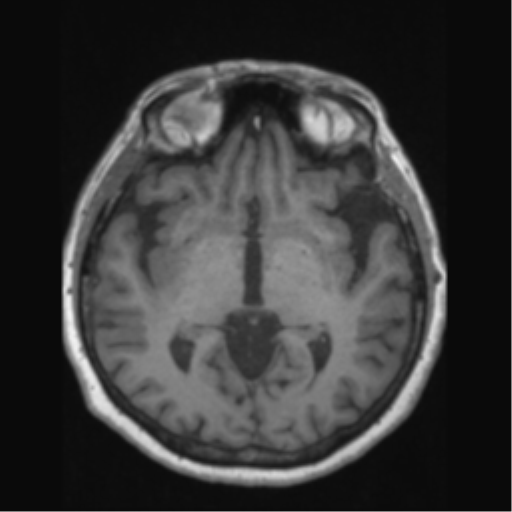 Anaplastic astrocytoma IDH wild-type (pseudoprogression) (Radiopaedia 42209-45276 Axial T1 74).png