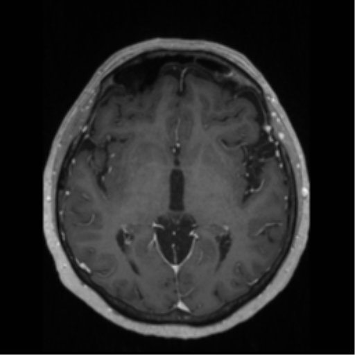 File:Anaplastic astrocytoma IDH wild-type (pseudoprogression) (Radiopaedia 42209-45276 Axial T1 C+ 73).png