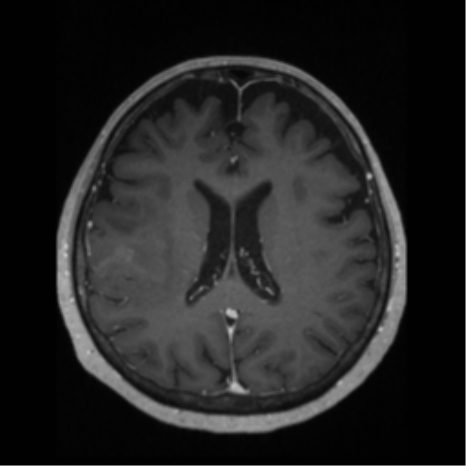 File:Anaplastic astrocytoma IDH wild-type (pseudoprogression) (Radiopaedia 42209-45276 Axial T1 C+ 91).png