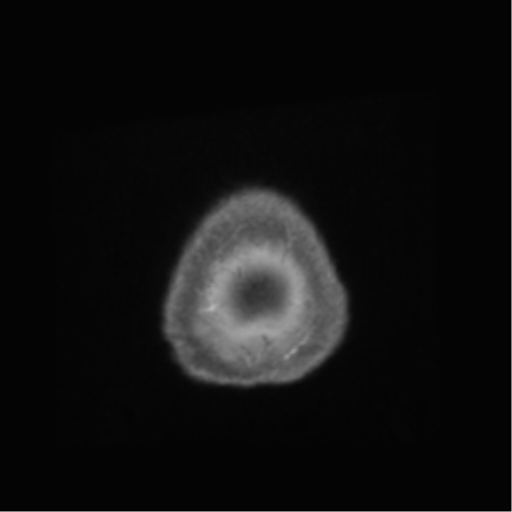 Anaplastic astrocytoma IDH wild-type (pseudoprogression) (Radiopaedia 42209-45278 Axial T1 C+ 154).png