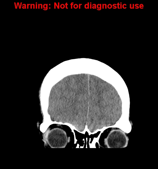 File:Anaplastic ganglioglioma (Radiopaedia 44921-48815 Coronal non-contrast 7).jpg