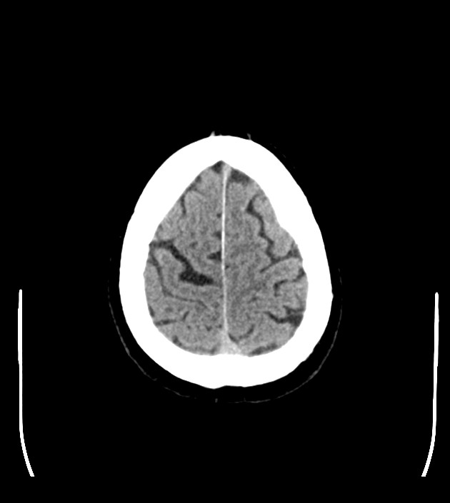 Anaplastic oligodendroglioma (Radiopaedia 79571-92753 Axial non-contrast 46).jpg