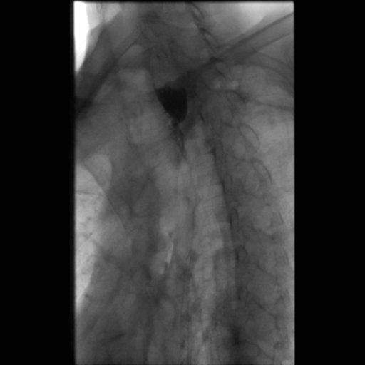File:Anastomotic stricture post Ivor Lewis esophagectomy (Radiopaedia 47937-52715 Oblique 1).png