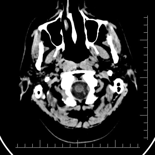 Aneurysm of posterior communicating artery (Radiopaedia 20188-20162 Axial non-contrast 2).jpg