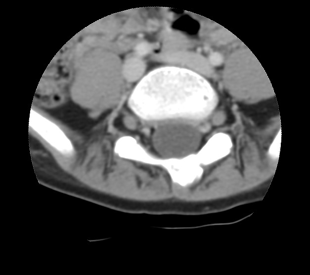 File:Aneurysmal bone cyst - sacrum (Radiopaedia 65190-74195 Axial non-contrast 12).jpg