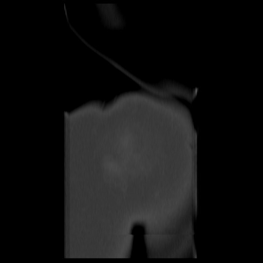 File:Aneurysmal bone cyst - sacrum (Radiopaedia 65190-74195 Coronal bone window 20).jpg