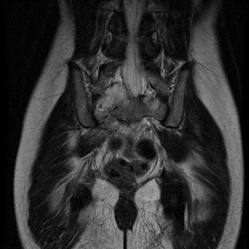 File:Aneurysmal bone cyst - sacrum (Radiopaedia 65190-74196 Coronal T2 11).jpg