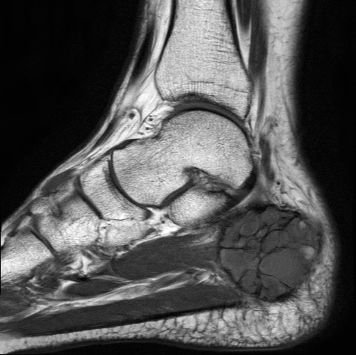 File:Aneurysmal bone cyst of the calcaneus (Radiopaedia 60669-68420 Sagittal T1 14).jpg