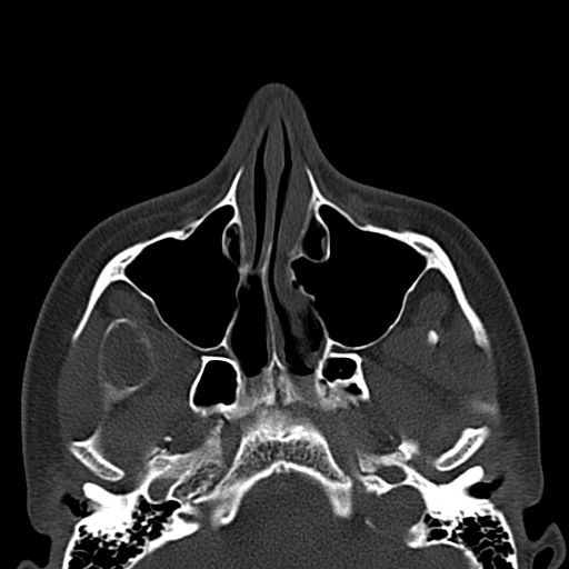 Aneurysmal bone cyst of the mandible (Radiopaedia 43280-46601 Axial bone window 73).jpg