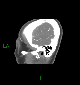 Aneurysmal subarachnoid hemorrhage with intra-axial extension (Radiopaedia 84371-99732 B 7).jpg