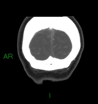 File:Aneurysmal subarachnoid hemorrhage with intra-axial extension (Radiopaedia 84371-99732 C 11).jpg