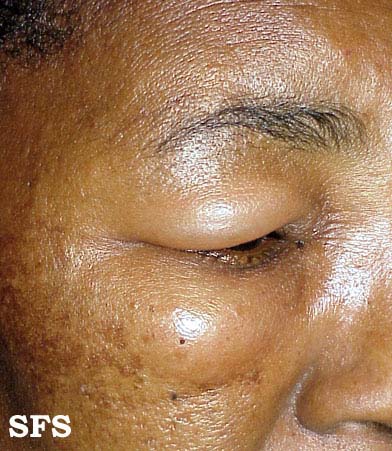 Angioedema (Dermatology Atlas 5).jpg