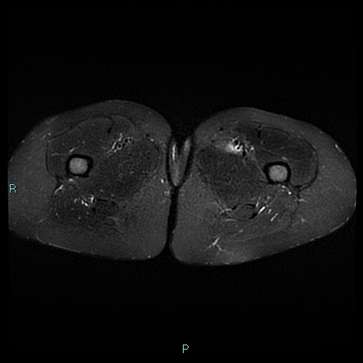 Angioleiomyoma (Radiopaedia 85442-101078 Axial STIR 31).jpg