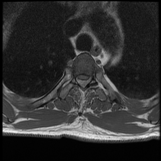 File:Angiolipoma - thoracic spine (Radiopaedia 28242-28479 Axial T1 25).jpg