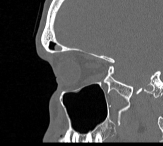 Angular epidermoid cyst (Radiopaedia 46908-51439 Sagittal bone window 66).png