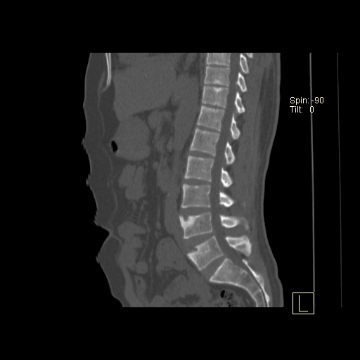 File:Ankylosing spondylitis (Radiopaedia 52728-58645 Sagittal bone window 11).jpg