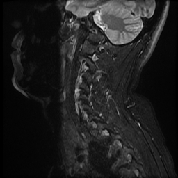 File:Ankylosing spondylitis - shiny corner sign (Radiopaedia 52084-57939 Sagittal T2 4).jpg
