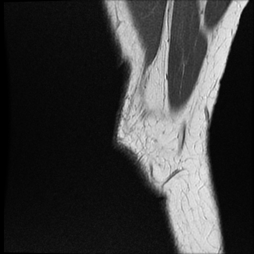 Anomalous insertion of the medial meniscus (Radiopaedia 77559-89721 Sagittal PD 51).jpg